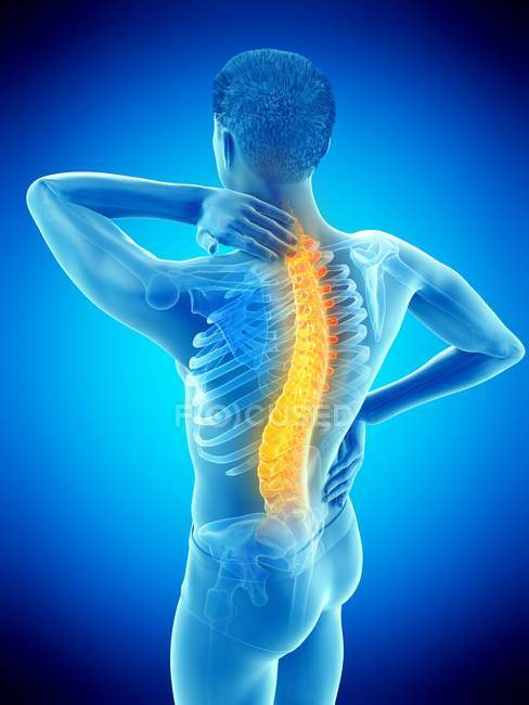 Male silhouette with back pain in high angle view, conceptual illustration. — Stock Photo