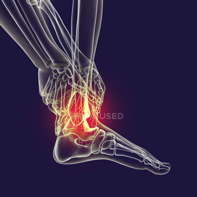 Hombre con dolor en el pie y esqueleto resaltado, ilustración por computadora. - foto de stock